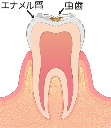 虫歯の進行状態（C1：エナメル質の虫歯）