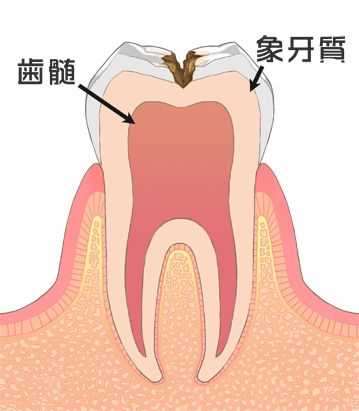 虫歯の進行状態（C2：象牙質の虫歯）