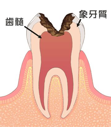 虫歯の進行状態（C3：神経に達する虫歯）