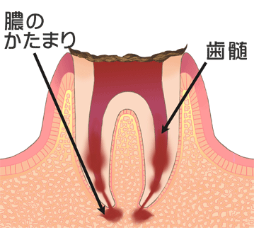 虫歯の進行状態（C４：歯根のみ残存）