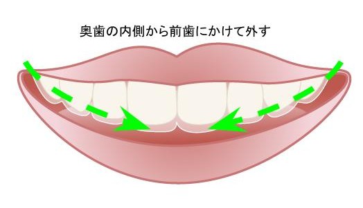 マウスピースの外し方1(左右奥歯の内側から)