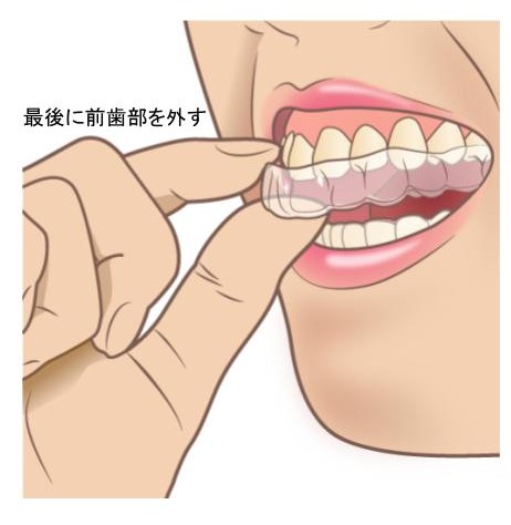 マウスピースの外し方2(最後に前歯部を取り外す)