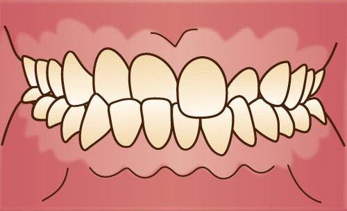 交叉咬合（クロスバイト）のイラスト（正面）