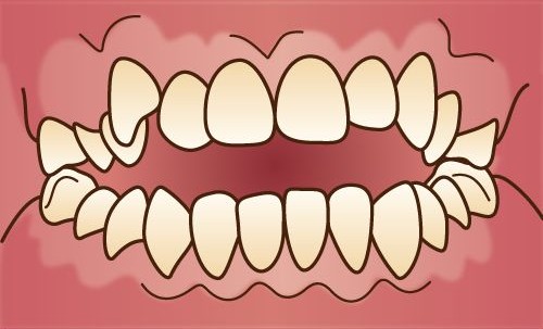 開咬（オープンバイト）のイラスト（正面）